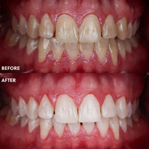 BeforeAfter-WHITENING.jpg