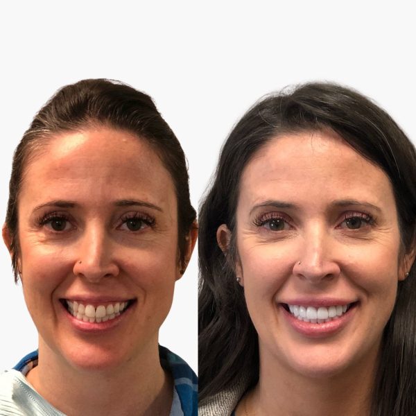 invisalign-before-after-1.jpg